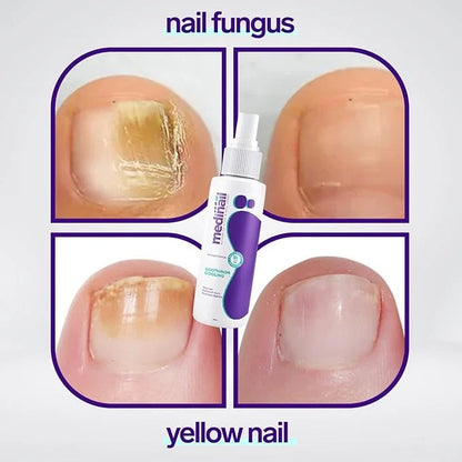 Jaysuin - Nail Fungus Spray